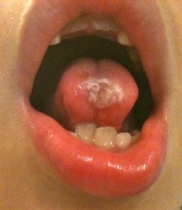 Mouth - Tongue Ulcer